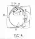 Fig. 03 - MINIMALLY INVASIVE APPARATUS AND METHOD FOR TREATING THE RETINA