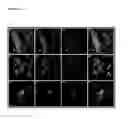 Fig. 14 - Composition and method for treating nucleic acid-related eye disease