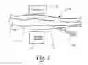 Fig. 02 - METHOD FOR DETECTION AND DISPLAY OF EXTRAVASATION AND INFILTRATION OF FLUIDS AND SUBSTANCES IN SUBDERMAL OR INTRADERMAL TISSUE