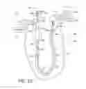 Fig. 05 - SUCTION CATHETER WITH DISTAL SUCTION MODULATION