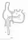 Fig. 05 - Multi-Directional Steerable Catheter