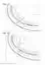 Fig. 04 - Expandable cardiac shunt