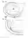 Fig. 09 - Expandable cardiac shunt