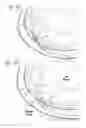 Fig. 10 - Expandable cardiac shunt