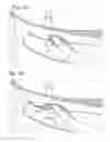 Fig. 11 - Expandable cardiac shunt