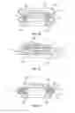 Fig. 06 - Fixation sleeve equipped leadless pulse generator