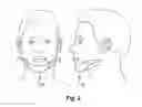 Fig. 03 - System and method for treating obstructive sleep apnea