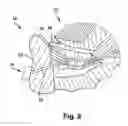 Fig. 09 - System and method for treating obstructive sleep apnea