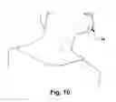 Fig. 10 - System and method for treating obstructive sleep apnea
