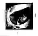 Fig. 04 - Utilizing depth from ultrasound volume rendering for 3D printing