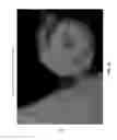 Fig. 06 - Utilizing depth from ultrasound volume rendering for 3D printing