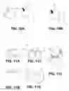Fig. 10 - Orthopedic implants having gradient polymer alloys