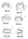Fig. 14 - Orthopedic implants having gradient polymer alloys