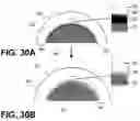 Fig. 16 - Orthopedic implants having gradient polymer alloys
