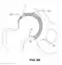 Fig. 46 - Orthopedic implants having gradient polymer alloys