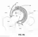 Fig. 54 - Orthopedic implants having gradient polymer alloys