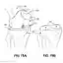 Fig. 55 - Orthopedic implants having gradient polymer alloys