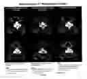 Fig. 03 - Method for Reduction of Artifacts and Preservation of Soft Tissue Contrast and Conspicuity of Iodinated Materials on Computed Tomography Images by means of Adaptive Fusion of Input Images Obtained from Dual-Energy CT Scans, and Use of differences in Voxel intensities between high and low-energy images in estimation of artifact magnitude