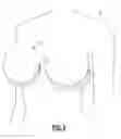 Fig. 05 - BREAST WEDGE SUPPORT APPARATUS AND METHOD