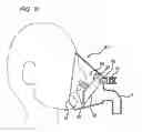 Fig. 12 - Airway adaptor
