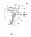 Fig. 05 - Sensing bone fixing element