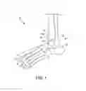 Fig. 02 - System and method for anterior approach for installing tibial stem