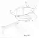 Fig. 08 - Surgical Method and Apparatus