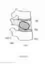Fig. 09 - Low cost low profile inflatable bone tamp