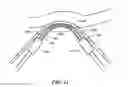 Fig. 11 - Post ablation tissue analysis technique