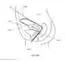 Fig. 60 - Method and devices for hysterectomy