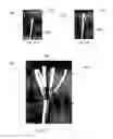 Fig. 75 - Method and devices for hysterectomy