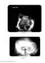 Fig. 83 - Method and devices for hysterectomy