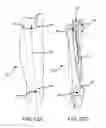 Fig. 13 - Surgical implant alignment device