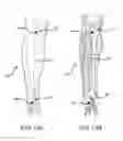 Fig. 14 - Surgical implant alignment device