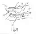 Fig. 10 - Bone foundation guide system and method
