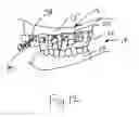Fig. 13 - Bone foundation guide system and method