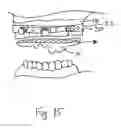 Fig. 16 - Bone foundation guide system and method