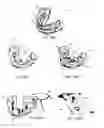 Fig. 16 - Method of using an endentulous surgical guide
