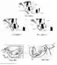 Fig. 17 - Method of using an endentulous surgical guide