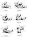 Fig. 20 - Method of using an endentulous surgical guide