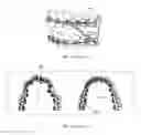 Fig. 02 - Spring based orthodontic device and methods of using thereof