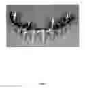 Fig. 06 - DENTAL PROSTHESIS AND METHOD OF ITS PRODUCTION UTILIZING STANDARDIZED FRAMEWORK KEYS AND MATCHING PREMANUFACTURED TEETH