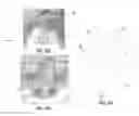 Fig. 09 - DENTAL PROSTHESIS AND METHOD OF ITS PRODUCTION UTILIZING STANDARDIZED FRAMEWORK KEYS AND MATCHING PREMANUFACTURED TEETH