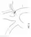 Fig. 17 - Vascular filters, deflectors, and methods