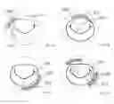 Fig. 06 - Prosthesis for preventing valve regurgitation