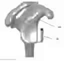 Fig. 01 - METHOD OF GLENOHUMERAL INSTABILITY REPAIR