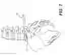 Fig. 09 - Minimally invasive biomaterial injection system