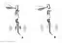 Fig. 01 - Objective, Real-Time Acoustic Measurement and Feedback for Proper Fit and Fill of Hip Implants