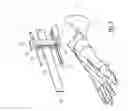 Fig. 06 - Surgical instrumentation assembly for positioning an ankle prosthesis