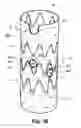Fig. 10 - Fenestrated stent grafts